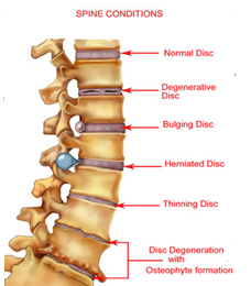 Spinal Decompression and Neuropathy